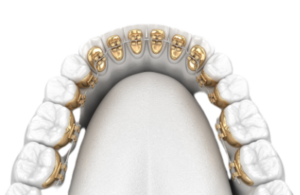 Dental Crowns and Veneers
