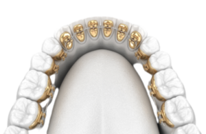 Dental Crowns and Veneers