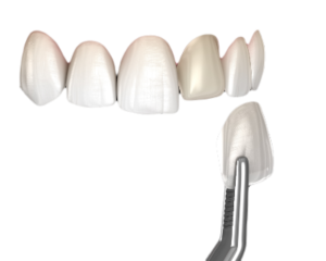 Dental Veneers